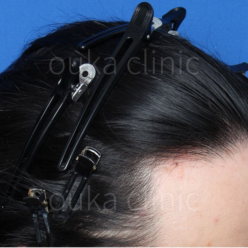 生え際の治療後の画像